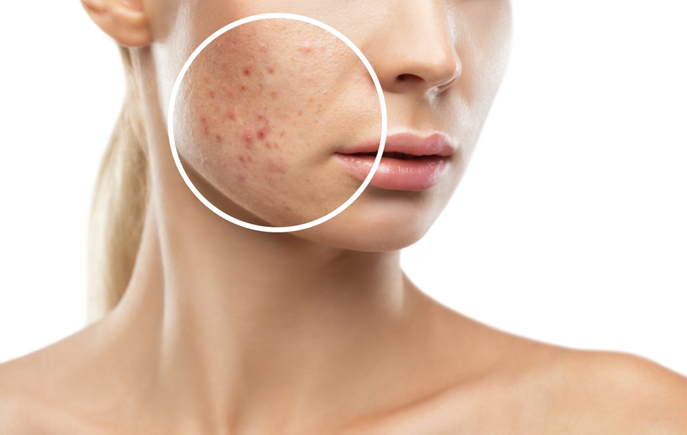 Cenzaa Acne